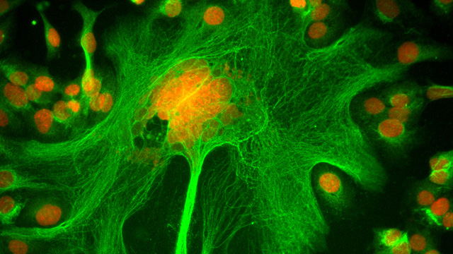 Research assistant at MD Anderson Cancer Center, Geoffrey Grandjean, obtained this image showing human ovarian cancer cells stained for DNA (red) and microtubules (green), during an siRNA screening. The particular gene knockdown in this screen disrupted cell division, causing the giant cell in the middle to grow very large. 2011 IN Cell Analyzer Image Competition