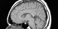 image: Alzheimer's Drugs Harmful?