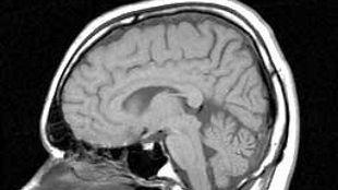 Alzheimer's Drugs Harmful? image: Alzheimer's Drugs Harmful?