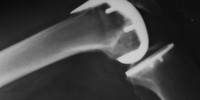 image: The Implant Melting Pot