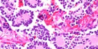 image: Fasting Heightens Chemotherapy Benefits