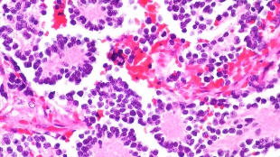 Fasting Heightens Chemotherapy Benefits image: Fasting Heightens Chemotherapy Benefits