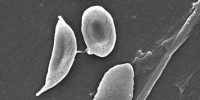 This scanning electron micrograph shows the morphological differences between normal red blood cells and a sickle cell red blood cell found in the blood of a patient with sickle cell anemia.CDC