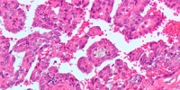 image: High Tumor Heterogeneity Confirmed