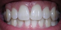 image: Dental X-rays Linked to Brain Tumors
