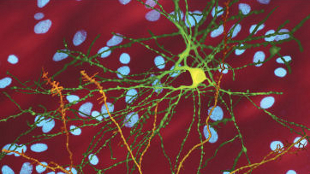 Huntington's Disease Protects from Cancer? image: Huntington's Disease Protects from Cancer?