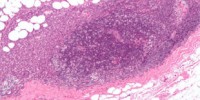image: Trials Overlook Cancer Spread