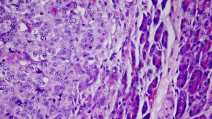 Cancer Exosomes Promote Metastasis image: Cancer Exosomes Promote Metastasis