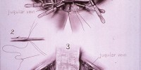 Second panel of William P. Didusch's illustration of Warfield Firor's experimental procedure for establishing cross circulation in dogs. The final step of the procedure involves the stitching stitching of the carotid artery of one dog to the other’s jugular vein. After the surgery, the pairs of dogs were bound together with adhesive plaster and kept unanesthetized so they could exercise, feed, and sleep at will.National Library of Medicine