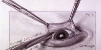 This is the first of five illustrations depicting Firor's dissection of a rabbit's eye. First, an incision is made at the conjunctiva of the lower eyelid.National Library of Medicine