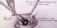 Figure 2 of Firor's operation of a rabbit's eye. Three additional incisions are made and the fat pad is removed.National Library of Medicine