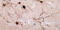 image: Parkinson's Vax Enters Clinical Trials