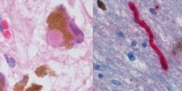 image: Parkinson’s Researcher Fabricated Data