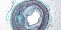 image: Epigenetic Drug Improves Cholesterol Levels