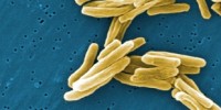 image: Do it Yourself TB Test