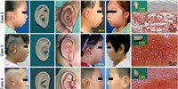 image: Children Receive Bespoke, Lab-Grown Ears